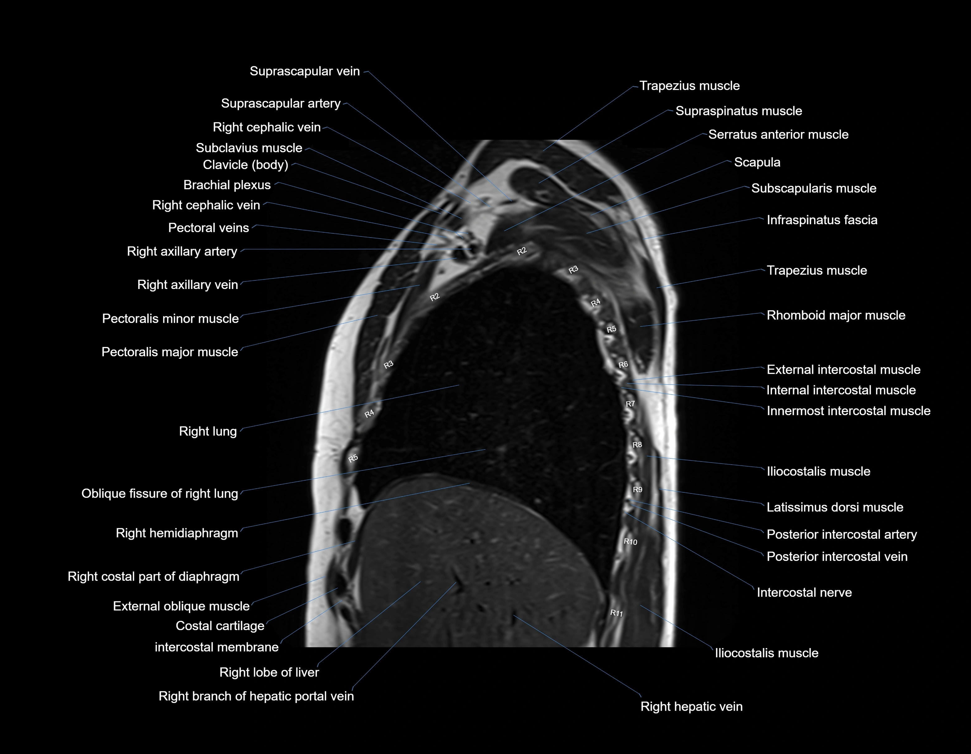 MRI chest (thorax) sagittal labelled cross sectional anatomy 3T radiology image-img-00001-00010.webp